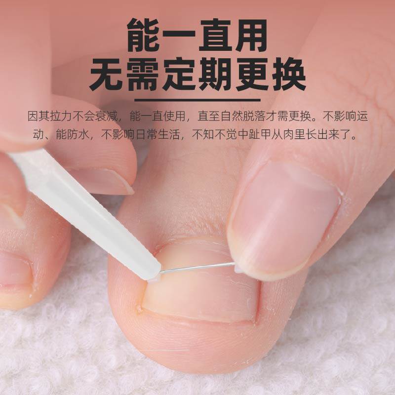 甲沟矫正器e嵌甲正甲贴甲片指甲内嵌纠正脚趾甲矫形专用神器炎扣