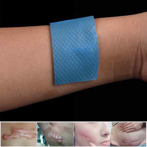 极速New Scar Away Patch Silicone Gel Sheet Wound Mark Remova