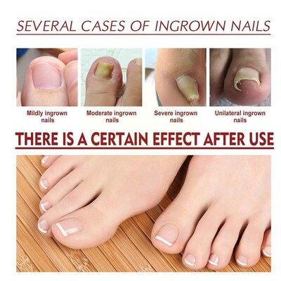 好货Nail Fungus Treatment Essence Care Oil Hand And Foot Gel