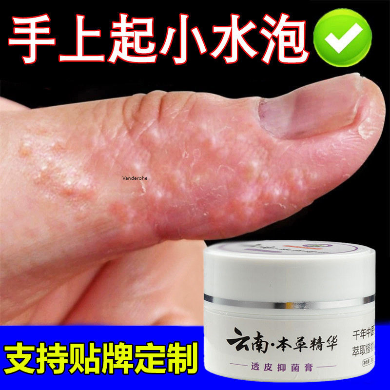 云南本草菌抑乳膏手上起小水泡药膏汗疱诊脱皮黑皮肤止Y五类产品0