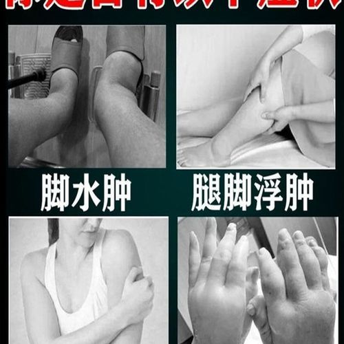 【当晚就消】消水肿喷剂下肢脚肿走不了路小腿脚肿水肿专用神器YN