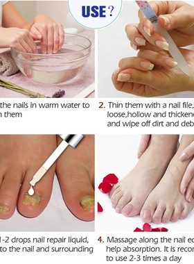 iBeaLee Repair Grey Nail Fungus Treatments Essence Foot Care