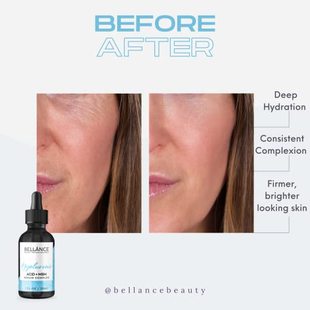 Aloe Serum Aging Anti Vera with Face for Acid Hyaluronic