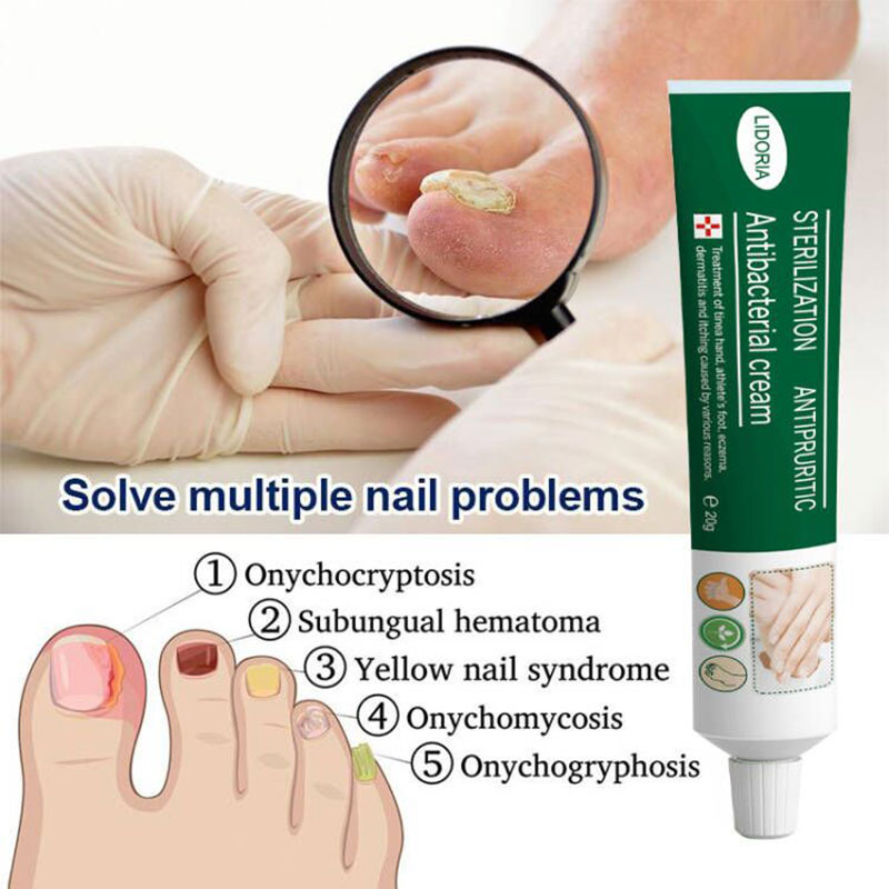 20g Foot Fungus Removal Ointment Hand And Foot Itching Ointm