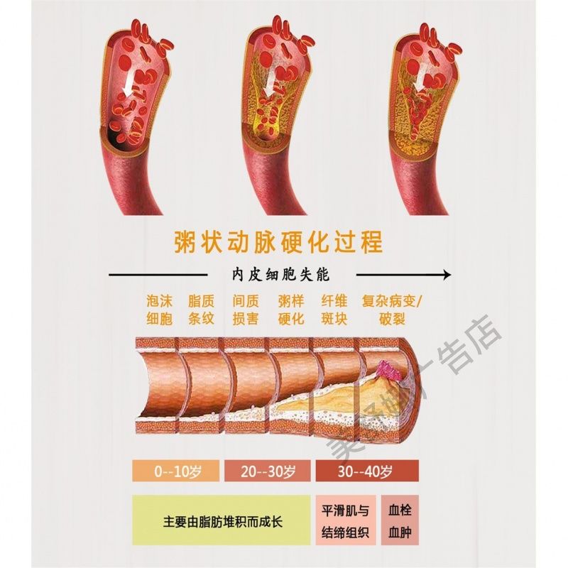 粥状动脉硬化过程内皮细胞失能广告海报宣传画贴纸装饰画定制kt板