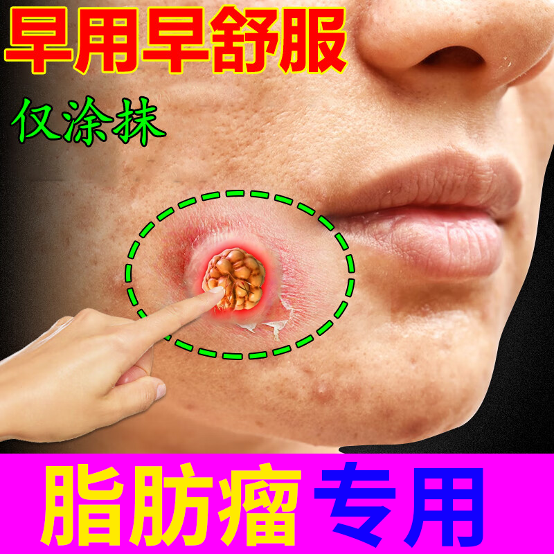 皮下脂肪瘤去除神器肿硬块去除皮脂腺囊肿膏皮肤纤维瘤消瘤膏om