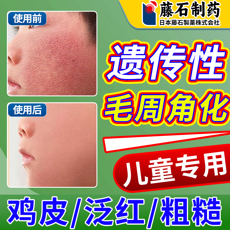 毛周角化症去角质面脸部上有小颗粒儿童鸡皮肤疙瘩毛囊角化膏OM