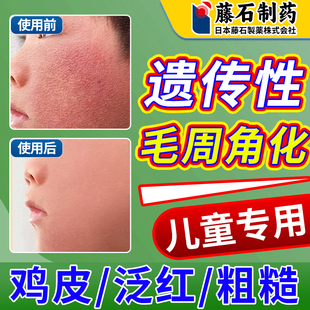毛周角化症去角质面脸部上有小颗粒儿童鸡皮肤疙瘩毛囊角化膏OM