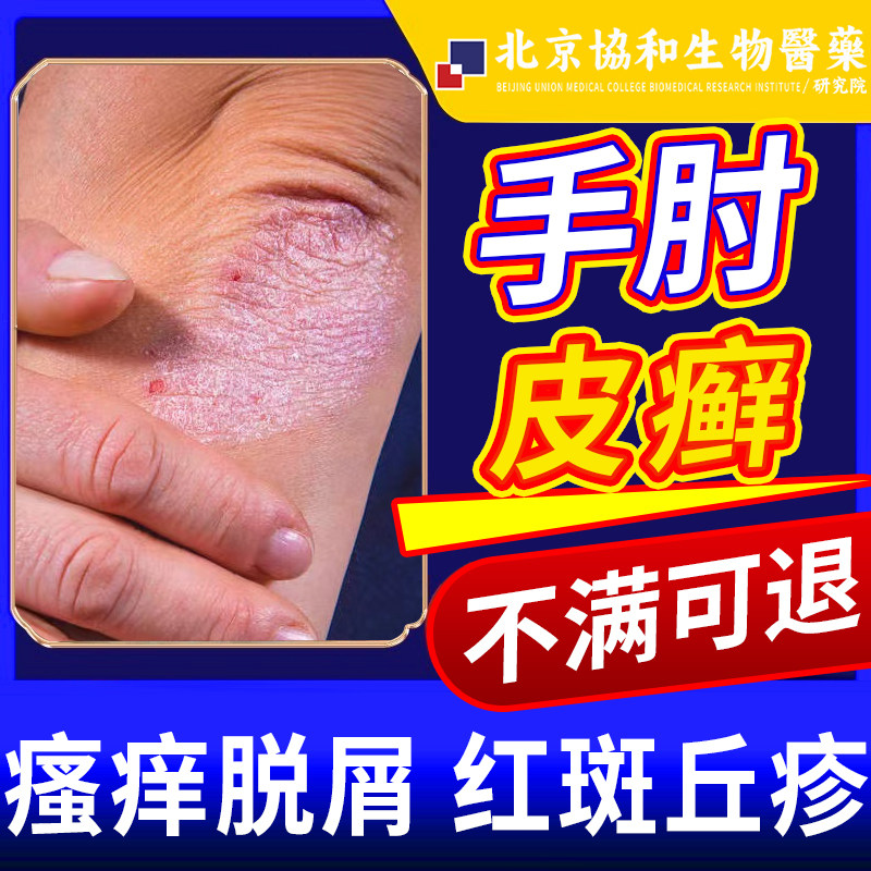 手肘癣胳膊肘癣止痒肚皮后背顽固性皮癣过敏止痒膏神经性皮炎yv