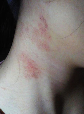 现货速发脖子起癣红痒颈部疙瘩头皮屑头皮癣头皮焱头痒湿毒红疹皮