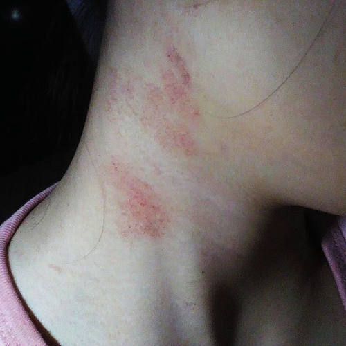 现货速发脖子起癣红痒颈部疙瘩头皮屑头皮癣头皮焱头痒湿毒红疹皮