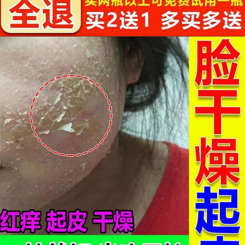 速发脸干燥起皮蜕皮过敏起癣长癣修复滋润霜碎有屑保痒止痒红湿药