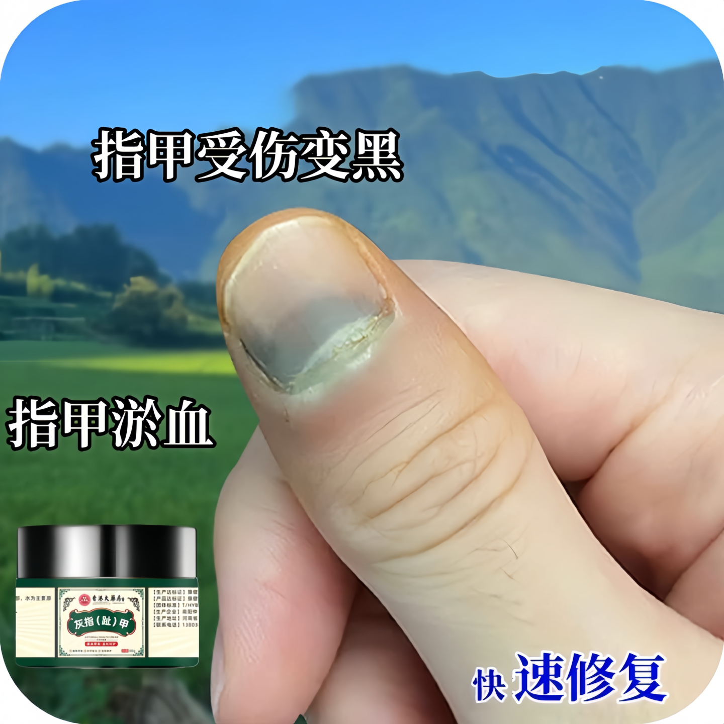 指甲淤血指甲受伤变黑发青指甲疼痛甲床分离活血化瘀修复灰指甲