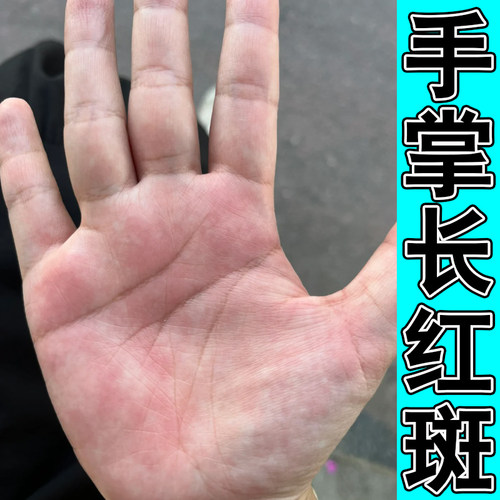 手上长水泡感染季节性出汗手掌心小红点痒红疙瘩草本修护膏
