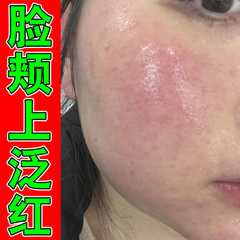 改善脸上有红血丝角质层薄修复红皮肤消毒护理（消）