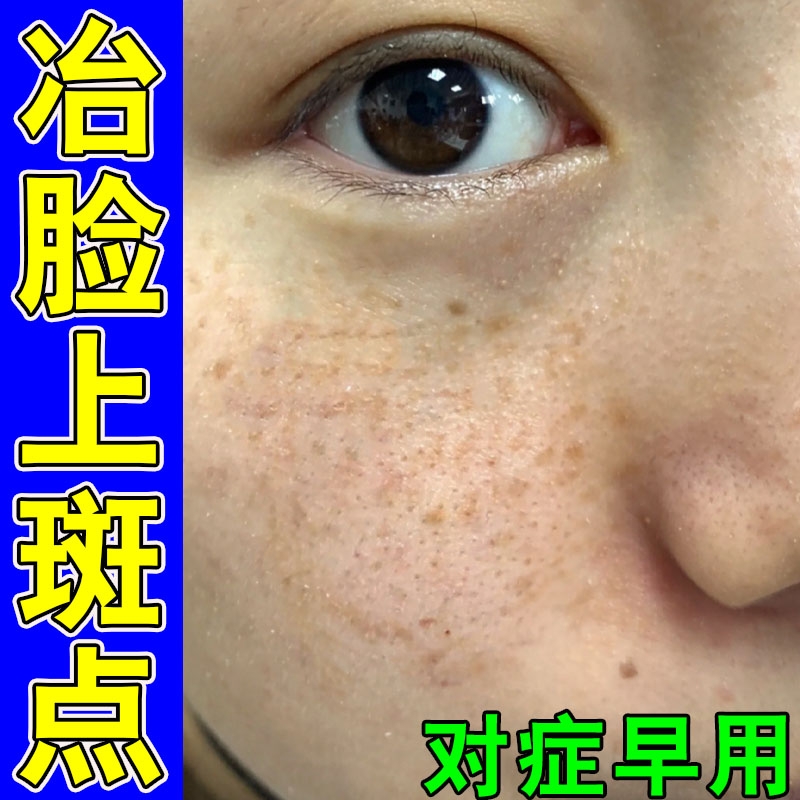 去斑脸上斑点专用膏去老年斑手部皮肤消毒护理（消）