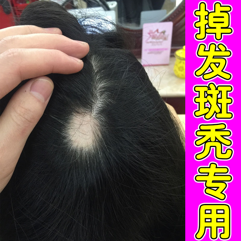 儿童斑秃鬼剃头药小孩防脱发专用皮肤消毒护理（消）