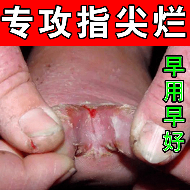 脚趾缝烂痒脱皮开裂糜烂药指间红肿溃烂出汗脚臭气真菌起水泡专用