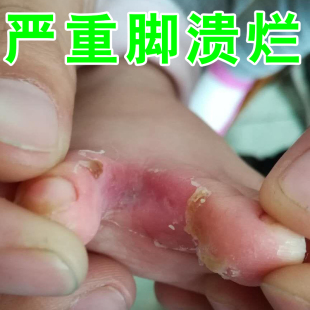 脚溃烂烂脚丫药专用香港脚脚趾缝烂痒脱皮干燥起皮糜烂发白沙虫脚