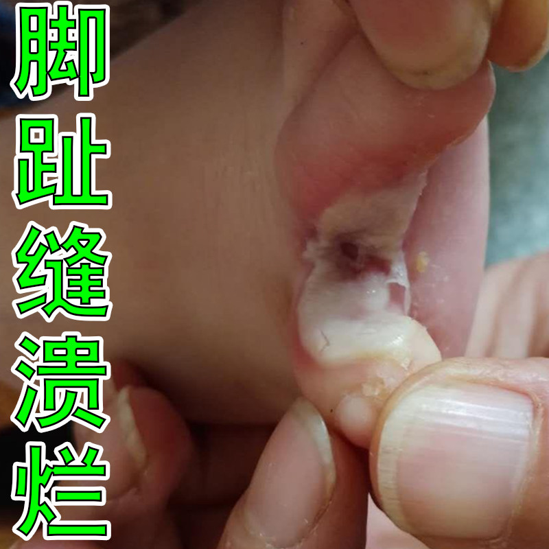 脚趾间烂去脚气膏药烂脚丫脱皮糜烂脚趾溃烂止痒脱皮杀菌真菌感染