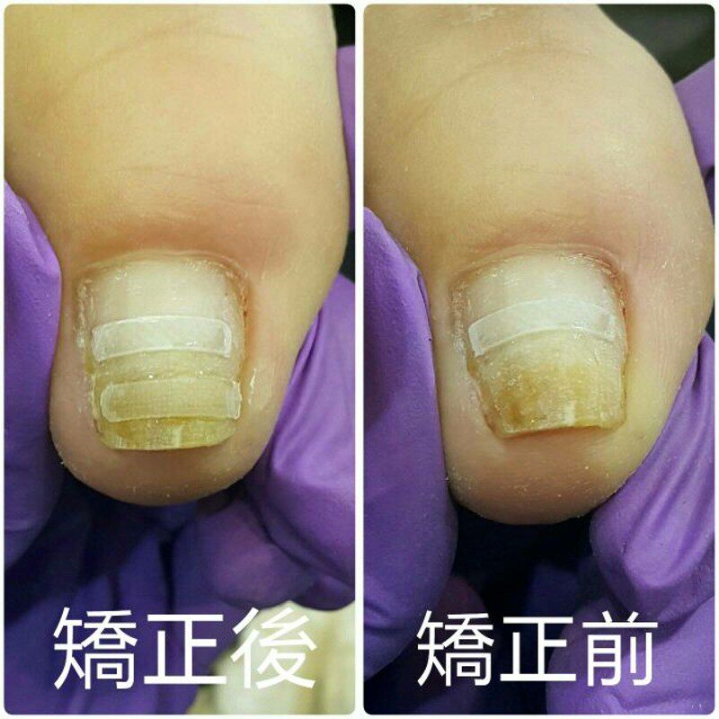 正甲贴甲沟嵌甲矫正器脚趾甲矫正拉D拉贴片专用指甲刀修脚套装钳