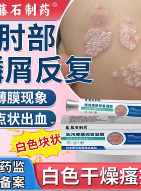 肘部鳞屑角化型癣白色块状干燥瘙痒皮肤表面受损出血特应性皮炎Q8