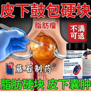 脂肪瘤单一个多个手臂大腿躯干脖子压迫摩擦皮下鼓包硬块囊肿膏RW