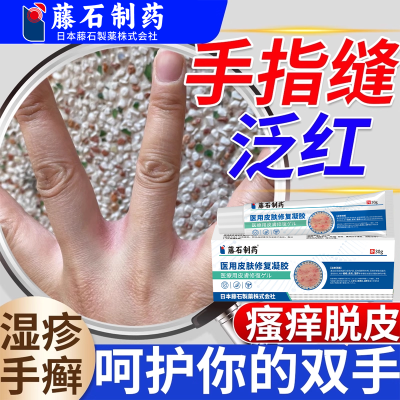 洗碗手指缝溃烂烂手丫药监备案