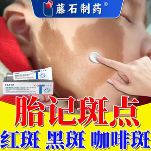 胎记除红斑黑斑咖啡斑褐斑遮盖遮瑕去膏淡化神器太田痣黑色素祛RW