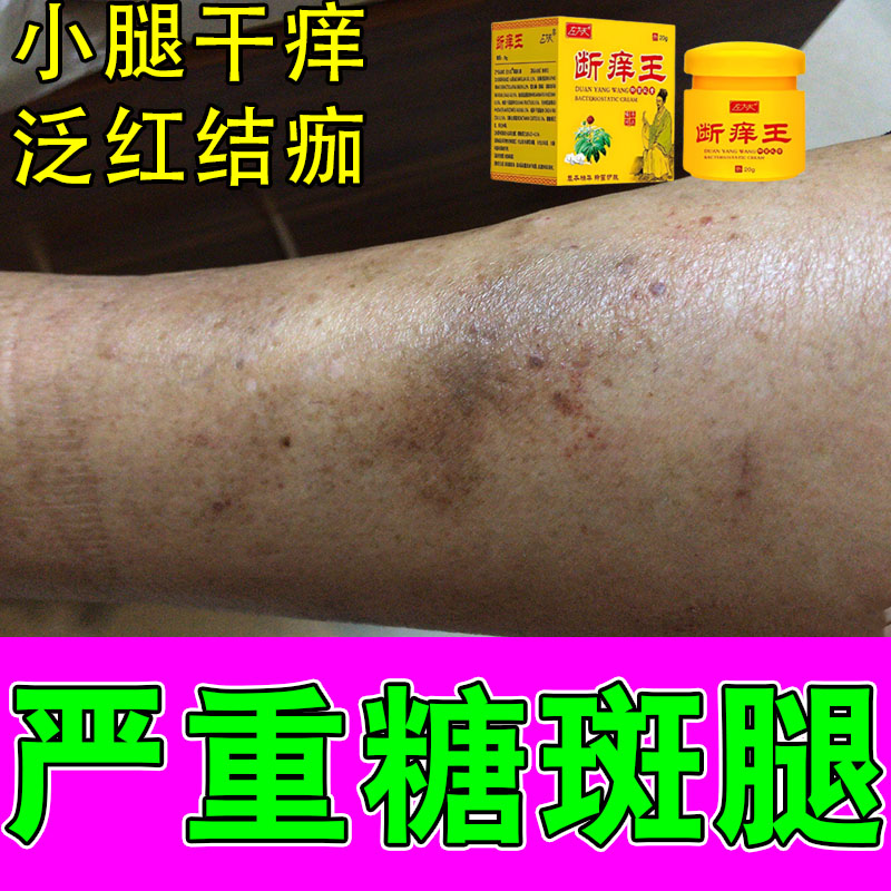 老人腿部皮肤干燥脱皮暗沉色素沉淀糖斑肌肤干痒疼痒舒缓植物护膏