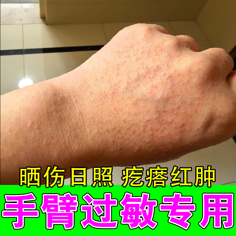 紫外线伤害日光敏感起疙瘩肿痛泛红太阳晒伤皮肤发痒舒缓修护膏