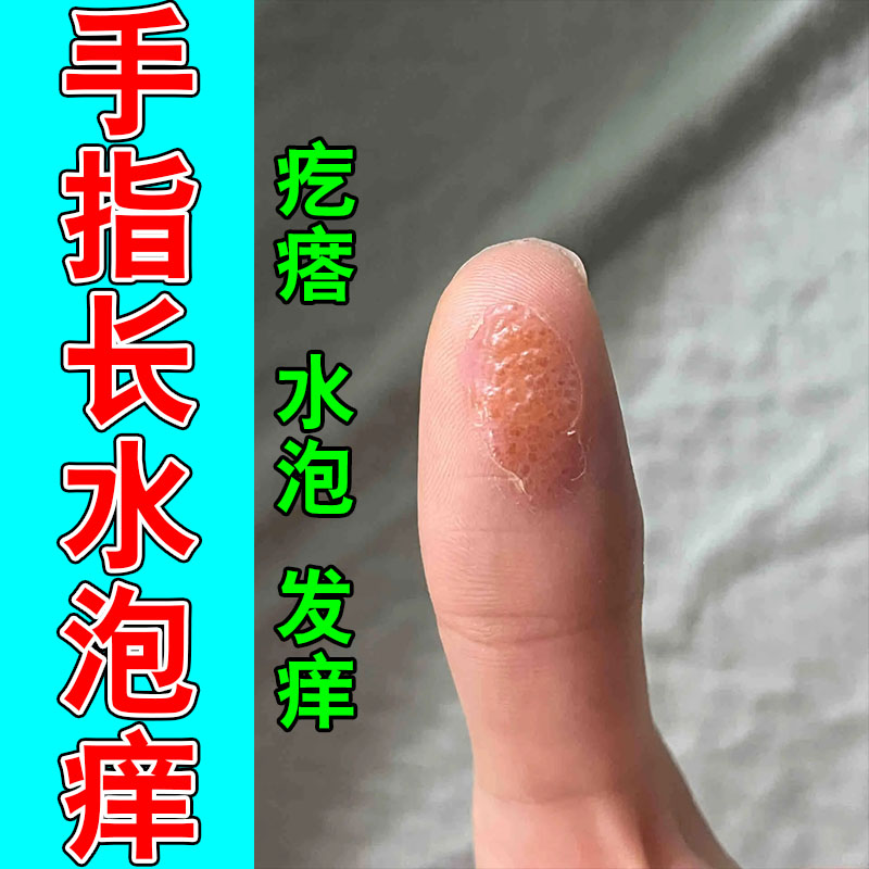 手指起水泡小疙瘩干痒起皮出汗疙瘩舒缓草本植物修护保湿膏