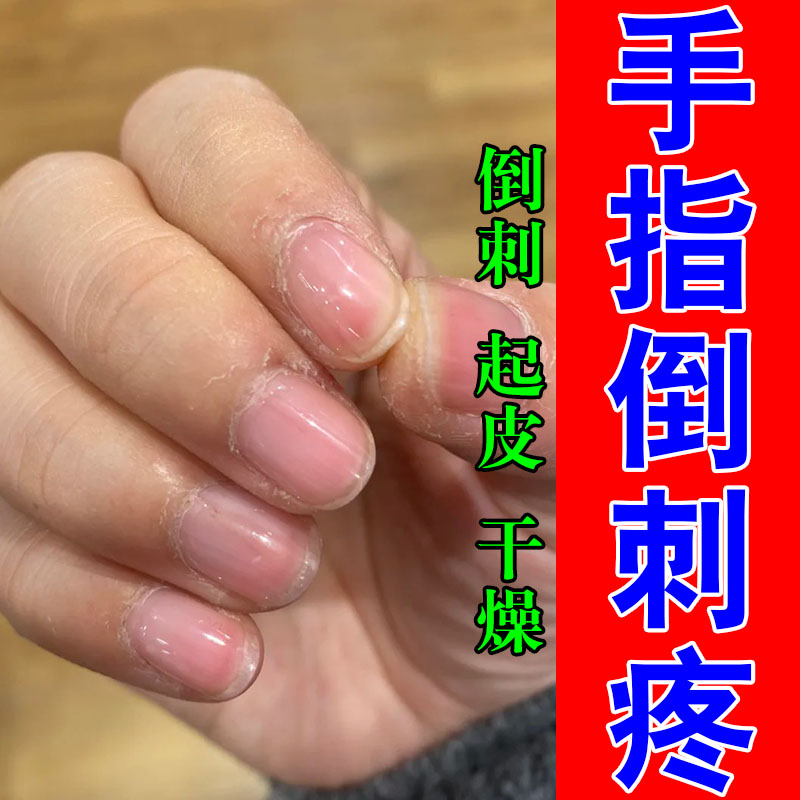 儿童专用手指倒刺草本膏乳修复护理手有肉刺边缘干裂起皮护手膏