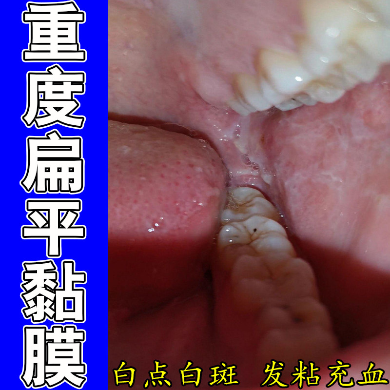 口腔白斑黏膜表层舒缓口腔内部纤维化不适草本口腔护理喷剂