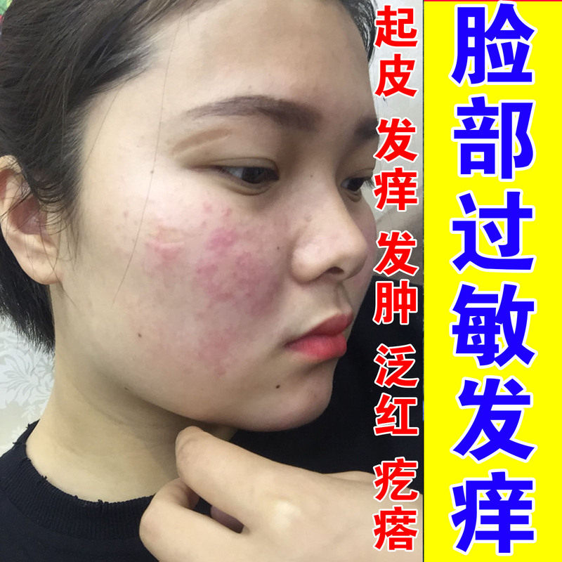 专用敏感肌膏脸上干燥起皮过敏皮肤修复脸部红痒脱皮有碎屑泛红膏