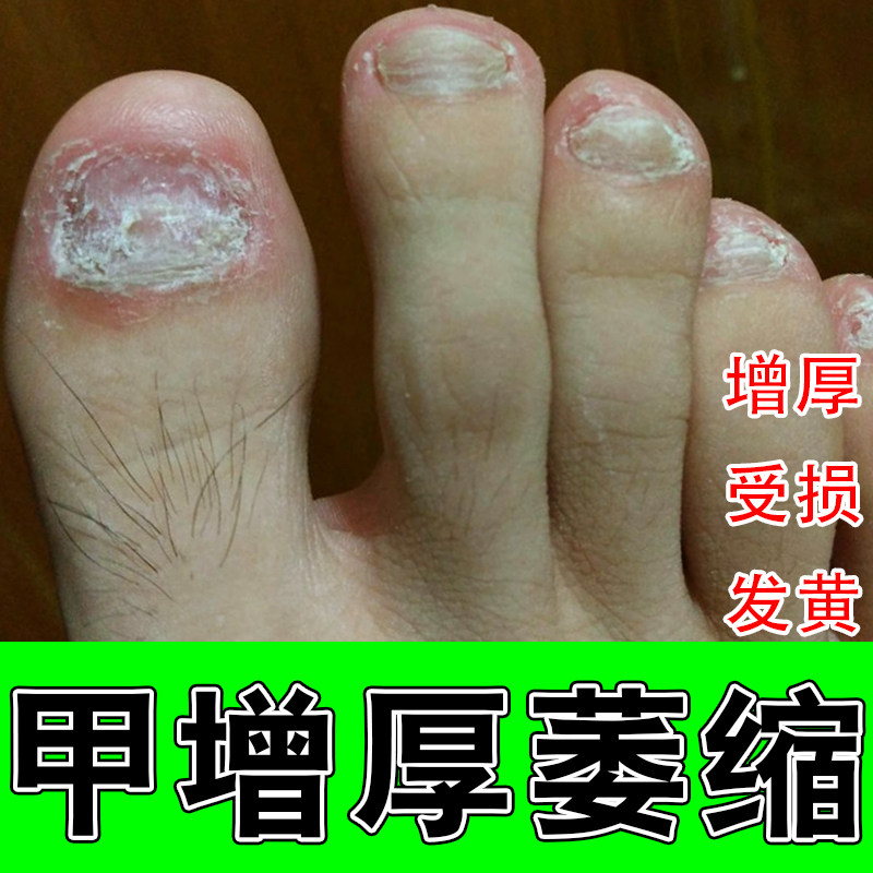 脚趾甲增厚变黄空黑白手指甲甲肉分离修复亮甲厚甲草本修护指甲液