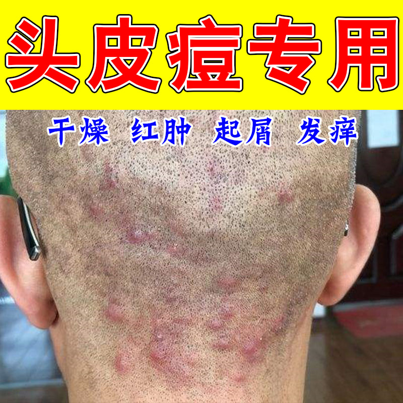 头上毛囊头皮长痘头部痒起红疙瘩有脓包头屑头皮疙瘩发痒草本软膏