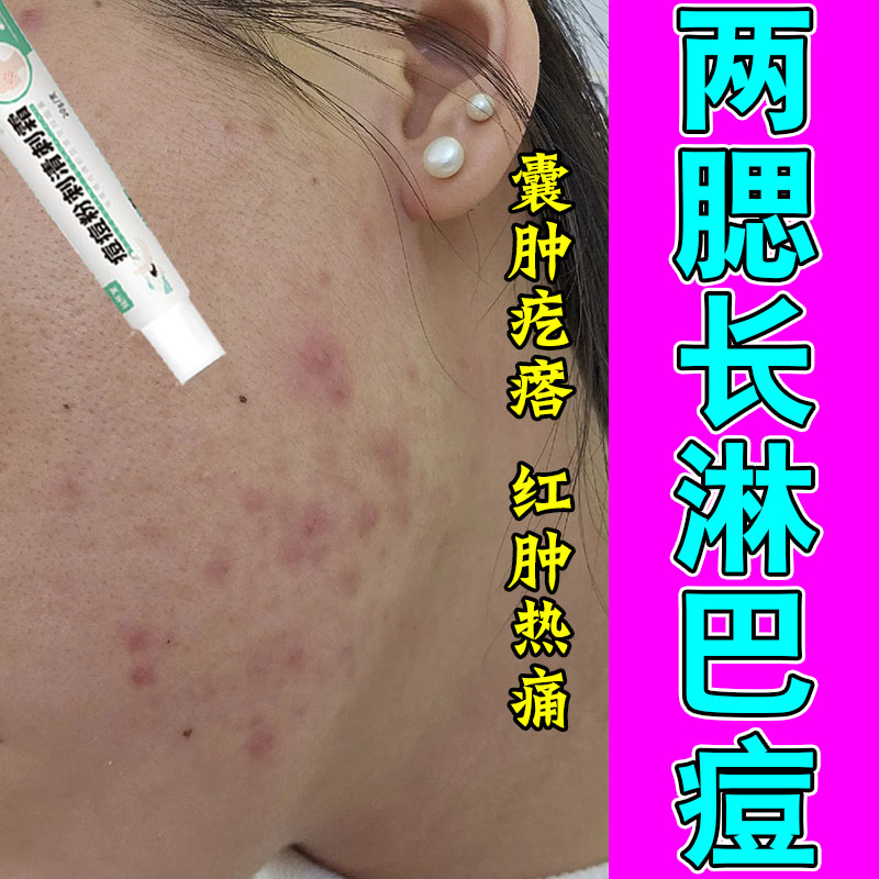 冶腮边长痘红硬闭口下巴疙瘩额头季节性上火过敏红肿修护保湿膏
