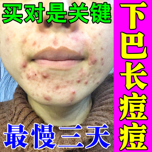 去下巴痘痘调理内调嘴巴周围下巴反复长痘治熬夜上火长青春疙瘩痘