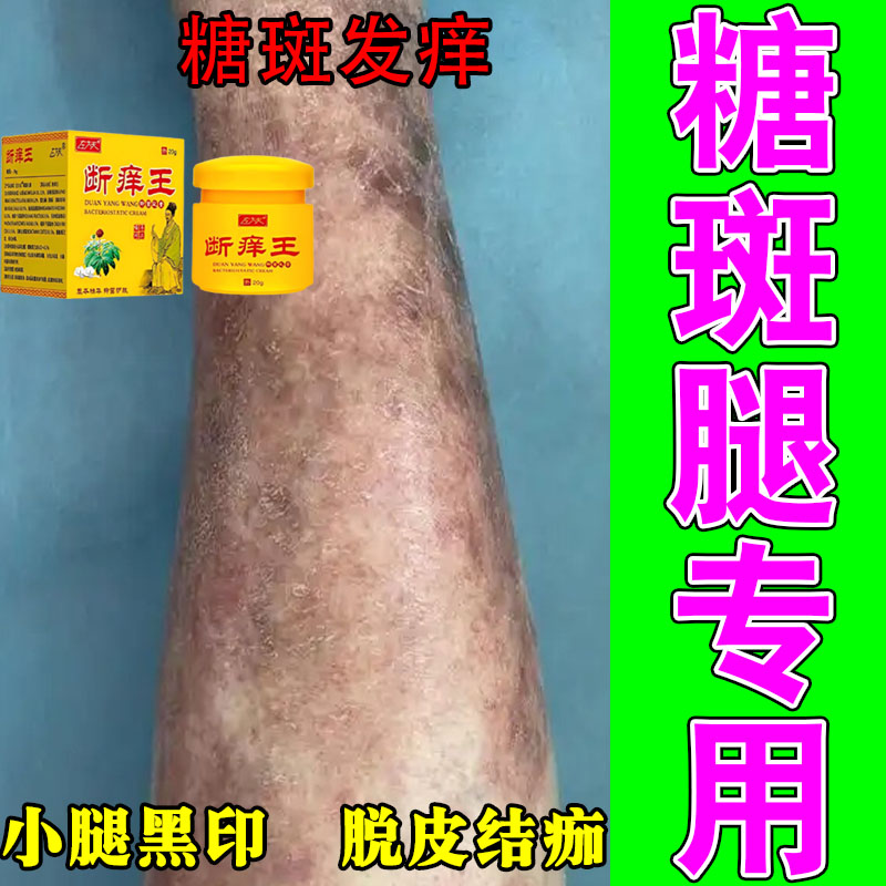 改善肌肤糖斑暗沉色素沉淀全身皮肤干燥脱皮反复疼痒植物修护肤膏