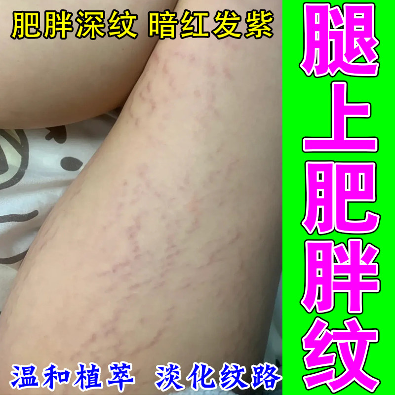 大腿肥胖纹修复膏生长纹大腿内侧肥胖纹男女通用专用草本修护乳膏