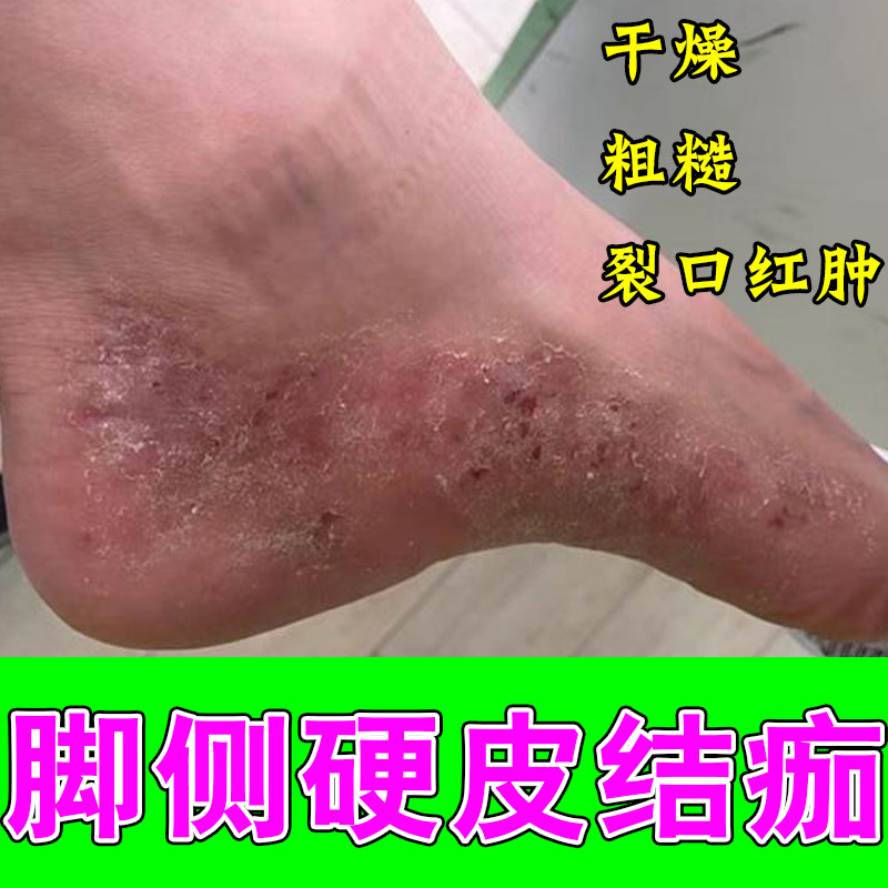 脚杆起皮水泡红痒脚杆痒真菌起皮顽固性皮肤痒痒脚侧长痒红肿膏