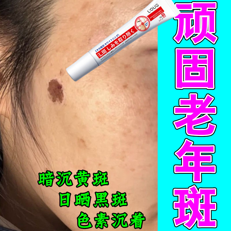 老年斑点长黑斑黄斑暗沉黑色素脸部黑斑黄斑雀斑保湿草本萃取软膏