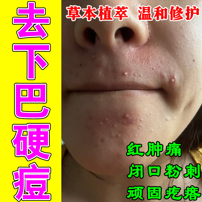 下巴额头上长痘闭口修复痘坑青春痘学生男女红肿疙瘩草本修护乳膏