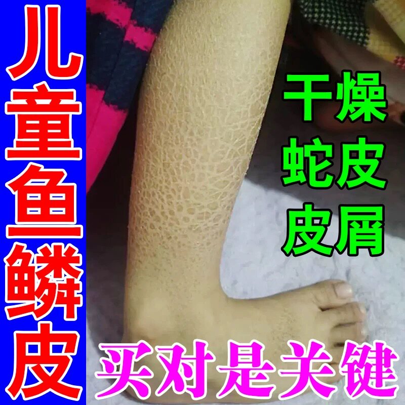 鱼鳞病皮肤霜儿童冬天皮肤干燥起皮身体乳保湿滋润去鱼鳞蛇皮皮屑