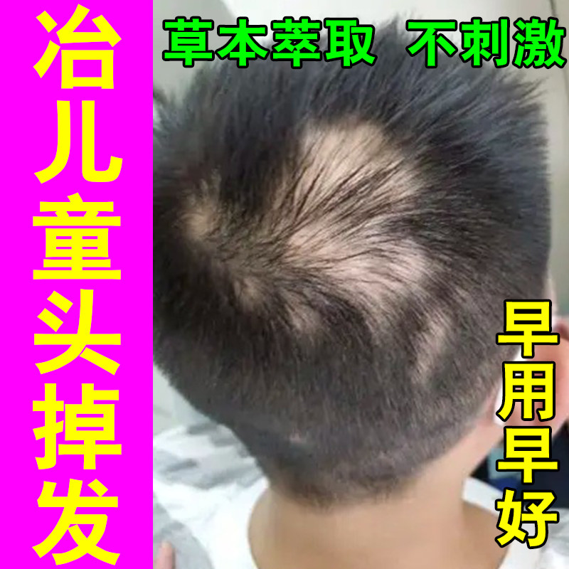 头顶梳头掉发多后脑勺光秃滋养头皮固发发量单薄草本育发修护喷剂
