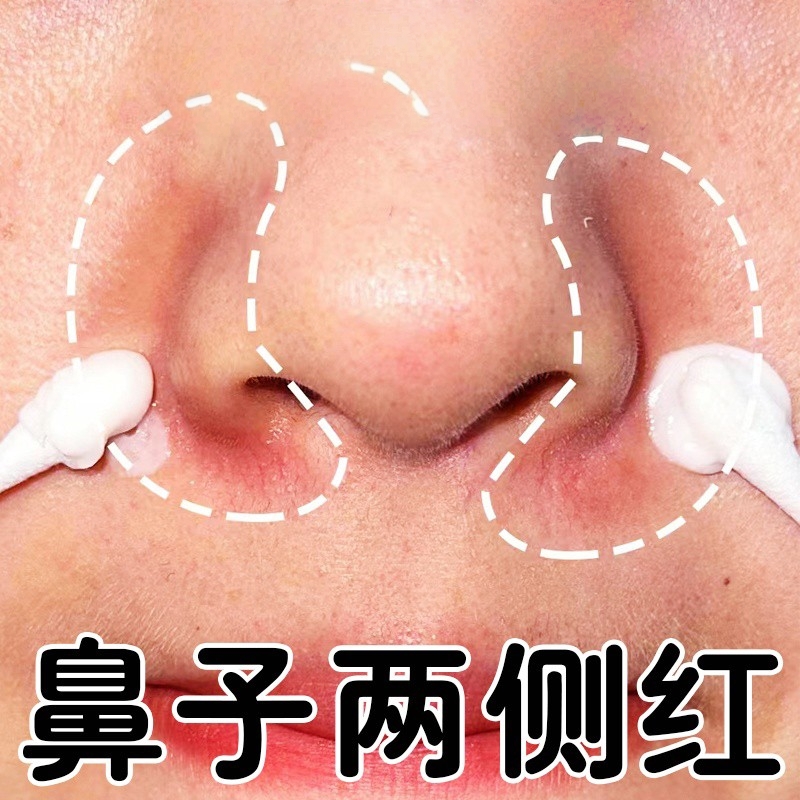 鼻翼脂溢性皮炎特效药膏治鼻子两侧发红脱皮鼻翼两边泛红干燥起皮