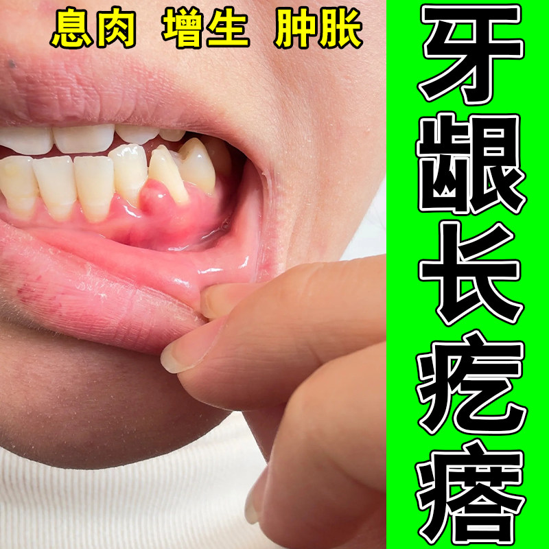 牙齿肿痛牙龈息肉增生上火红肿牙龈脓包植物舒缓修护喷剂