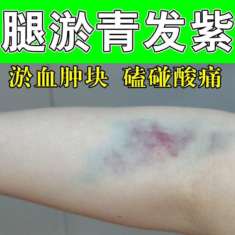 腿上淤青活除瘀化去血膝盖摔磕撞伤发紫跌损打伤外用淤青消膏