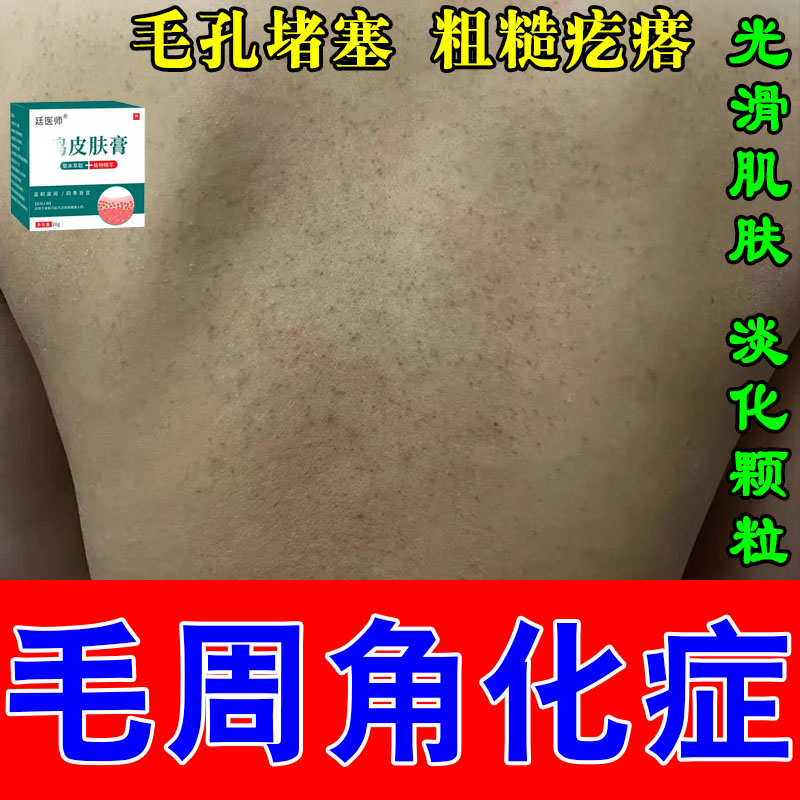 冶手臂鸡皮疙瘩毛囊毛周角化胳膊腿上红黑点角质毛孔堵塞修护霜
